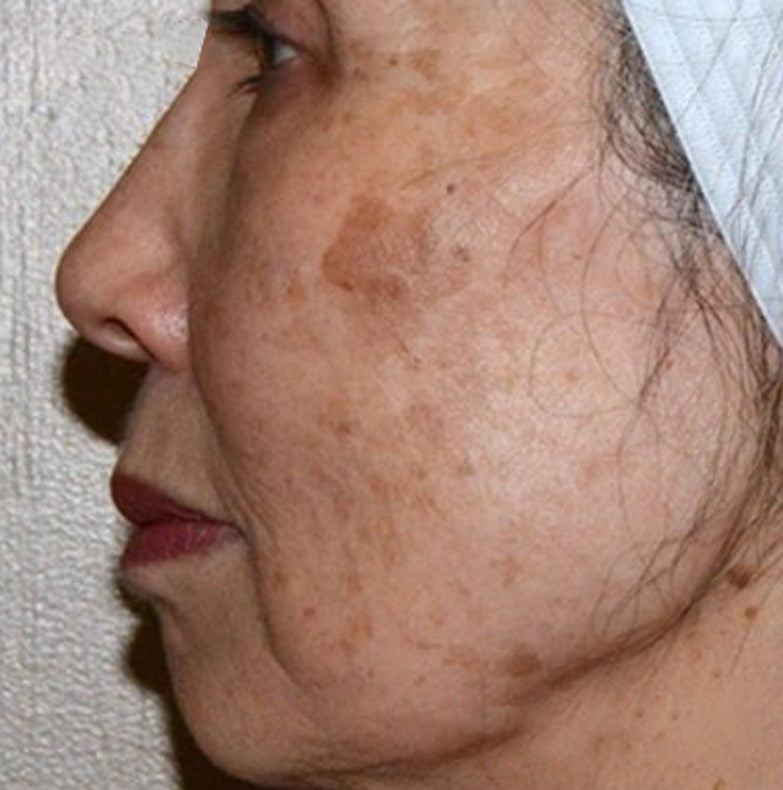 Before PICO Laser treatment — real consented client result, LLC Cosmetic