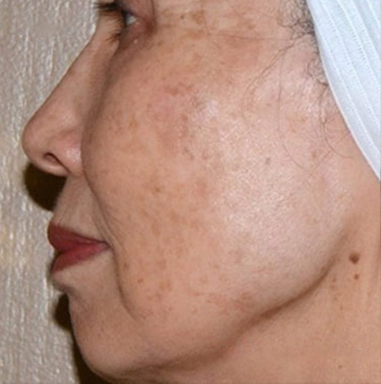After PICO Laser treatment — real consented client result, LLC Cosmetic