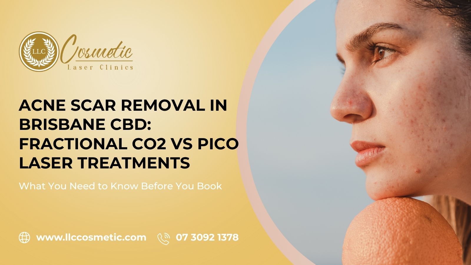 Acne Scar Removal in Fractional CO2 vs Pico Laser Treatments