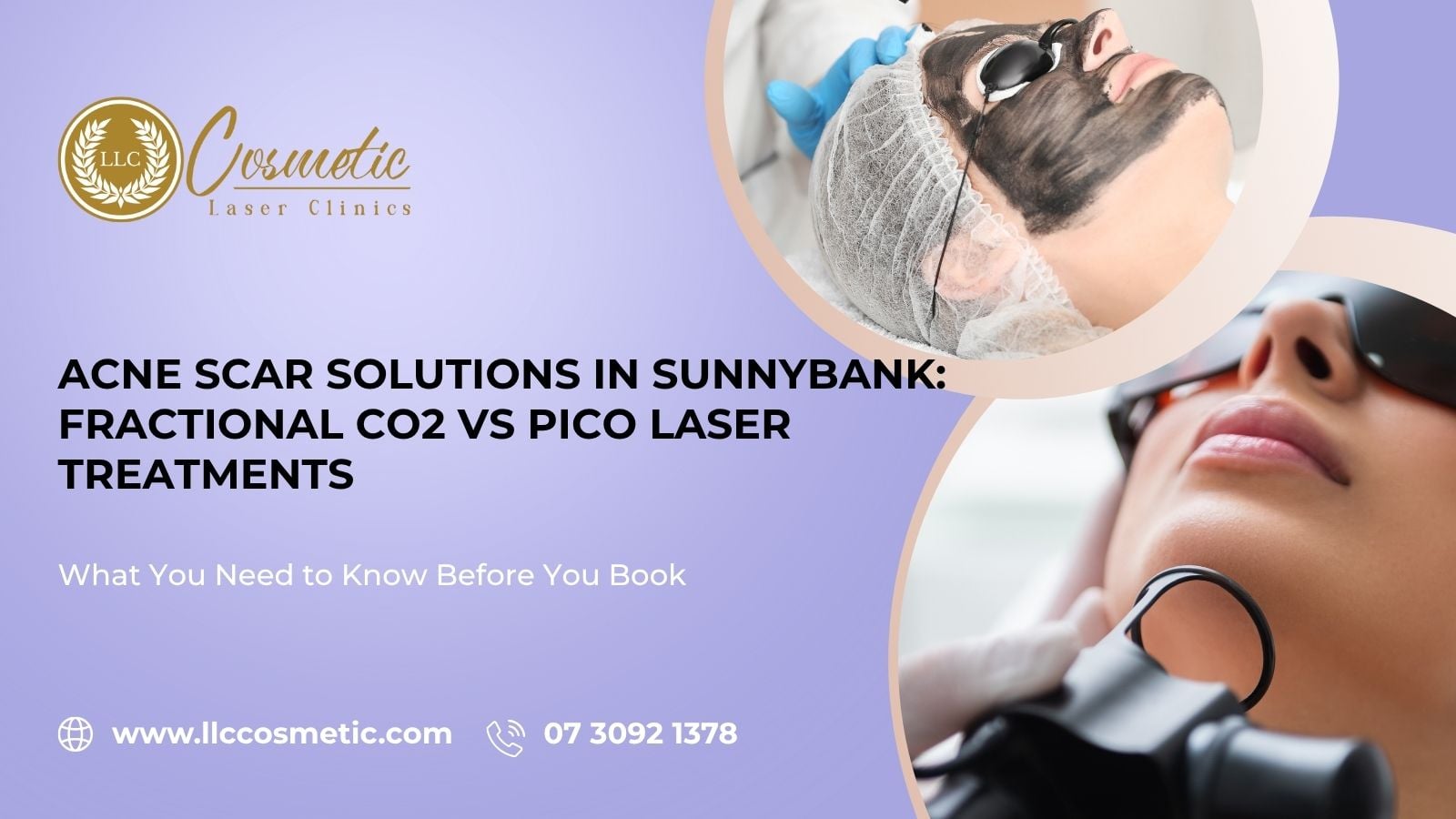 Acne Scar Solutions, Sunnybank, Fractional CO2 vs Pico Laser Treatments