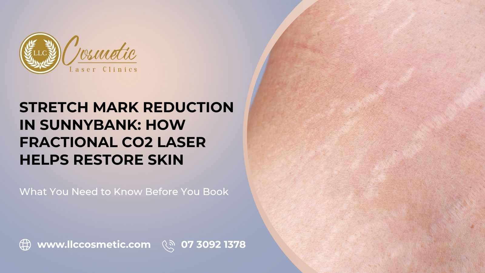 Stretch Mark Reduction, Sunnybank How Fractional CO2 Laser, Restore Skin