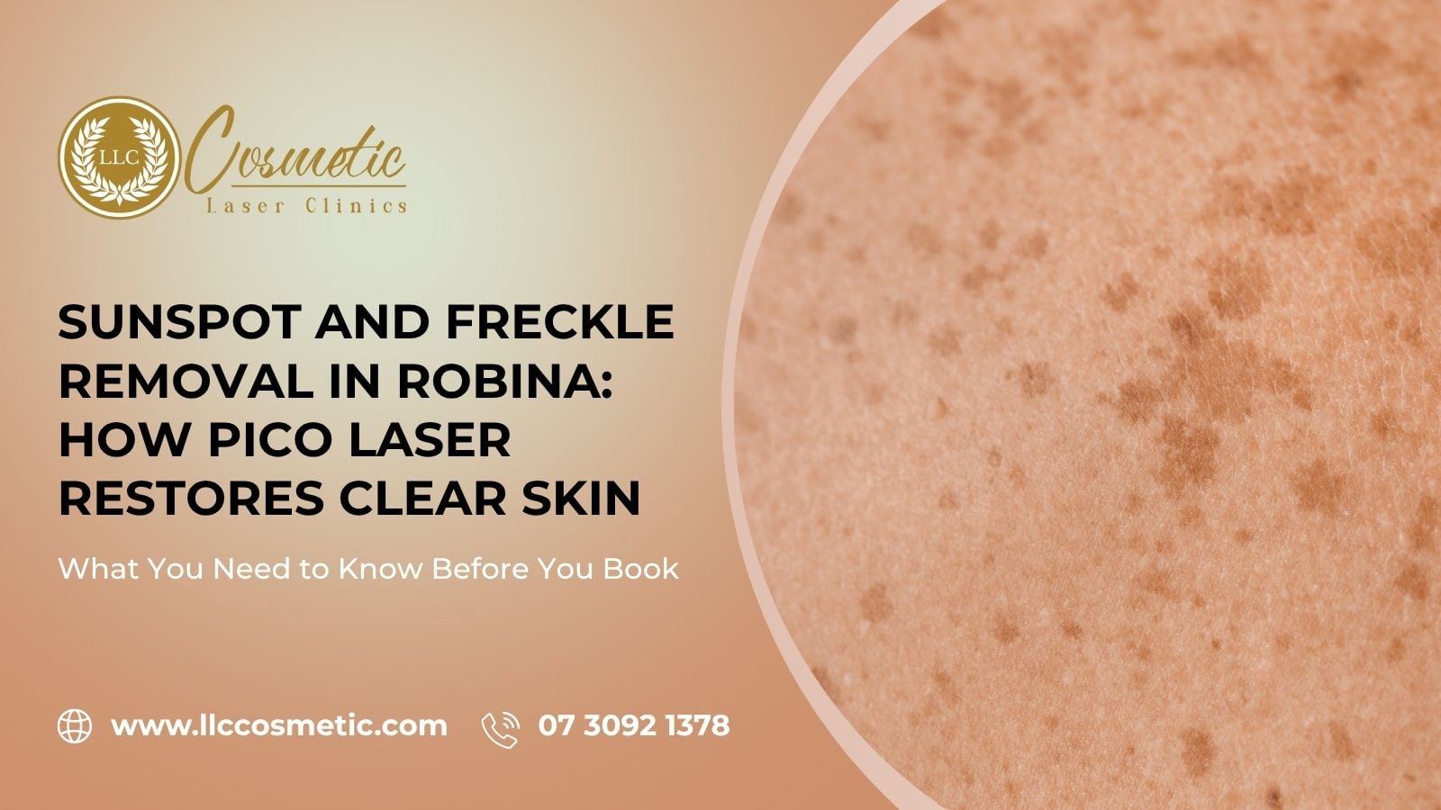 Sunspot, Freckle Removal in Robina, How Pico Laser Restores Clear Skin