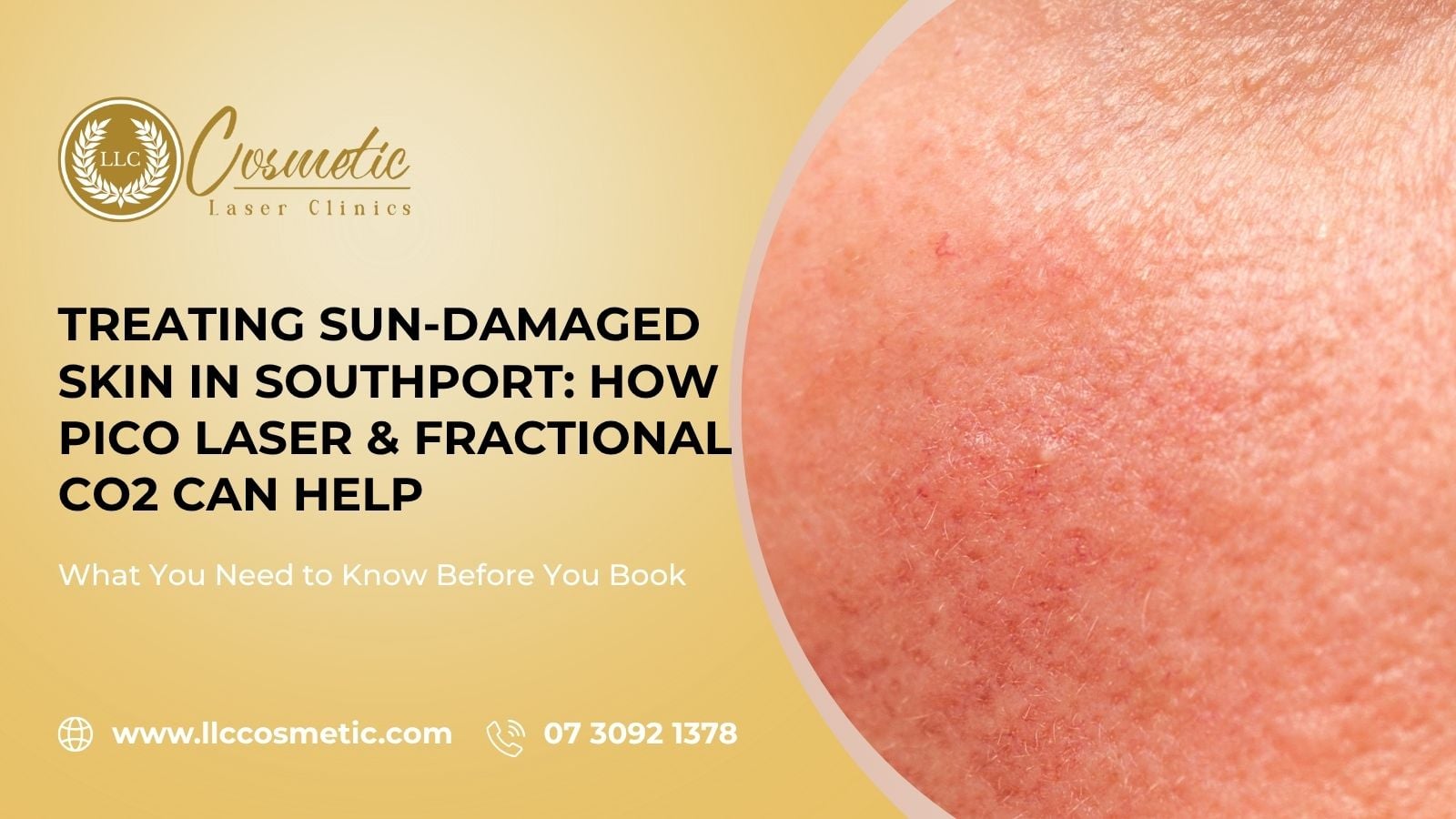 Treating Sun-Damaged Skin, Southport, How Pico Laser, Fractional CO2 Can Help