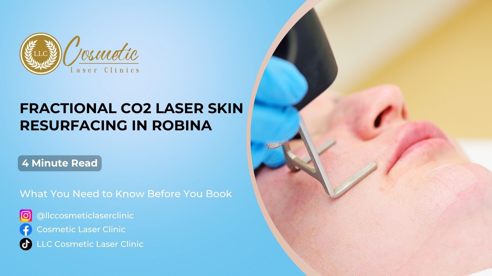 Fractional CO2 Laser Skin Resurfacing in Robina